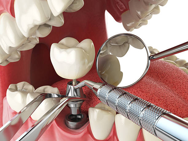 Best Emergency Dental Extractions in Sebastian, TX